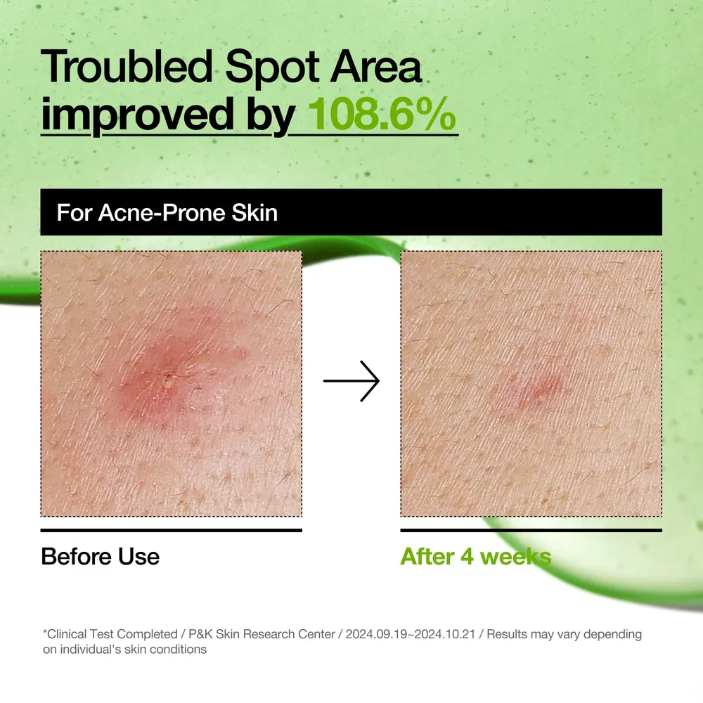 Anua Azelaic Acid 10 Hyaluron Redness Soothing Serum 30ml - Official Product Image | Abdulghani Trading